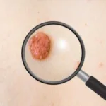 Avoid the Misdiagnosis of Melanoma