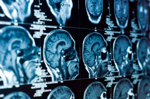 Florida brain injury attorney looking at MRI scans of a brain