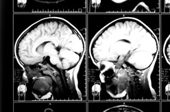 brain injury and brain scan